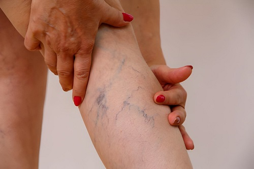 Best Doctor for Clots in Leg Veins in Vile Parle, Mumbai